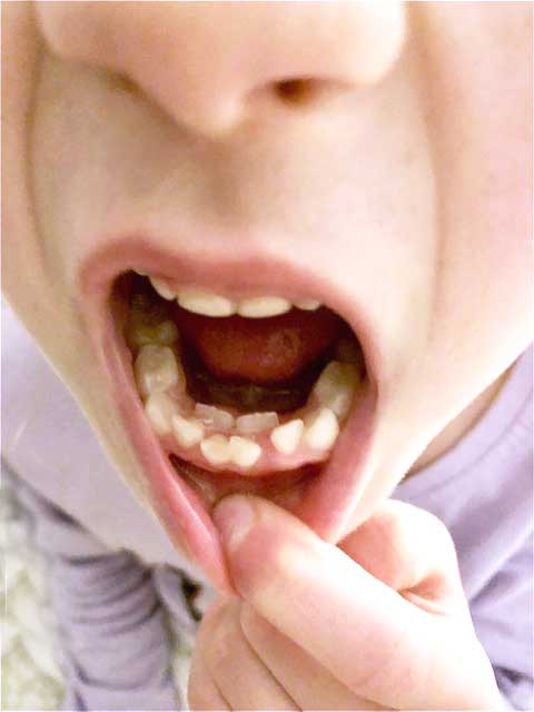 Double row of primary teeth
